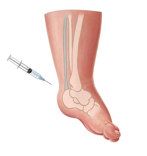 Emma Scheltema Illustration - Clubfoot Tenotomy for Starship Child Health