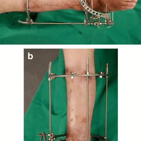 Clinical Picture Of An Attached Ilizarov Fixator For Simultaneous