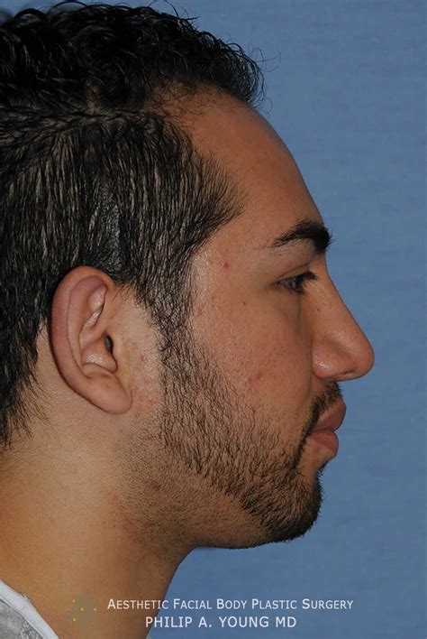 Chin Implant Reshaping Before After Photos