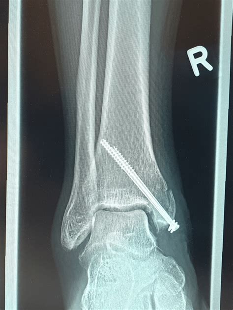 Medial Malleolus Fracture R Brokenbones