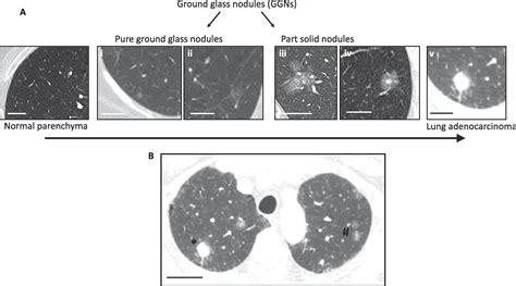 Adenocarcinoma Spectrum Lesions Of The Lung Detection Pathology And