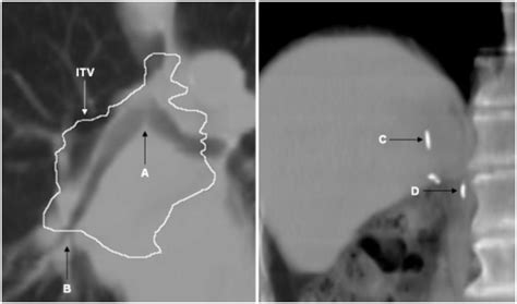 Tumor Surrogates Imaged In Patient 1 Left Were The Carina Bifurcation