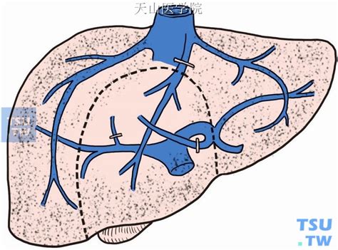 【附图】 肝中叶切除术 外科手术学 天山医学院