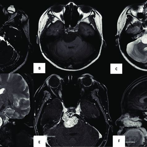 Preoperative brain MRI shows a mildly compressing mass on the right... | Download Scientific Diagram