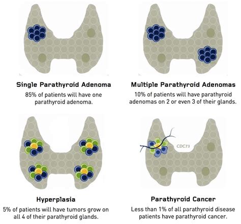 Hyperparathyroidism Hyperparathyroidism Surgery Dr Babak Larian
