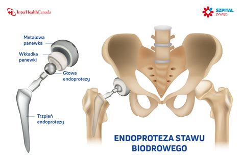 Endoproteza Biodra Co Musisz Wiedzie Szpital Ywiec