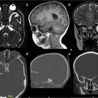 CT scan imaging. a CT scan showing lytic bone lesions of the vertebrae ...