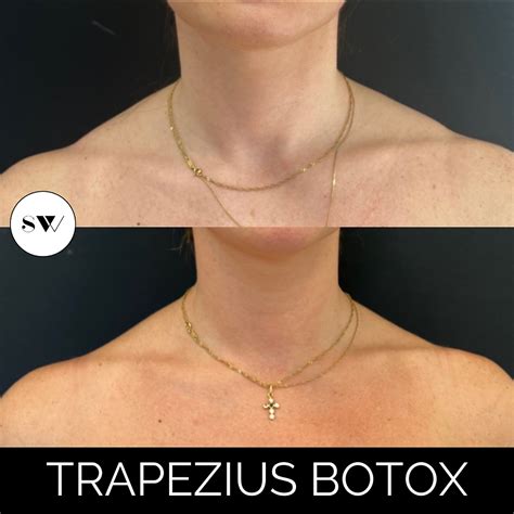 Trapezius Botox Traptox What Is It And Do I Need It