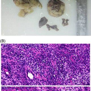 A Gross Appearance Of The Resected Tumor Was A Graywhite Tissue The