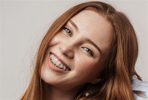 What Are Spacers Orthodontic Separators For Braces