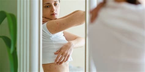 Stress Rash Causes Symptoms And Treatments