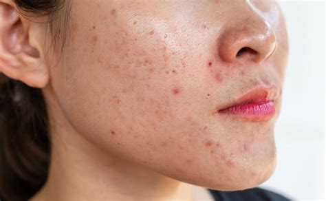 Whats Causing My Adult Acne Sanford Dermatology