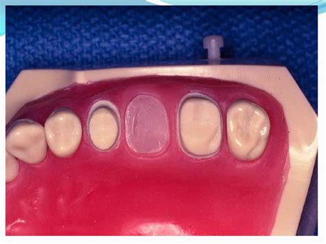 Dentistry: Introduction to Fixed Prosthodontics