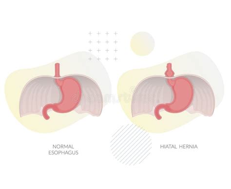 Hiatal Hernia Hiatal Hernia And Normal Anatomy Of The Stomach Stock