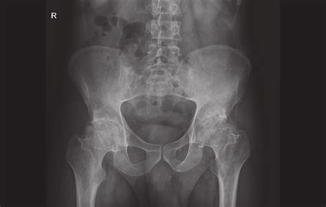 Plain Radiography Of Pelvis In Patient 1 Disclosing Bilateral Grade 4 Download Scientific