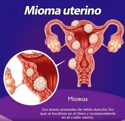 Miomas Con Omnilife Favorece El Funcionamiento Hormonal De La Mujer