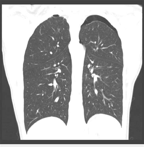 Patients High Resolution Chest Computed Tomography Showing Bilateral