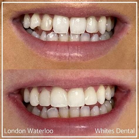 Composite Bonding Before And After Photos Whites Dental