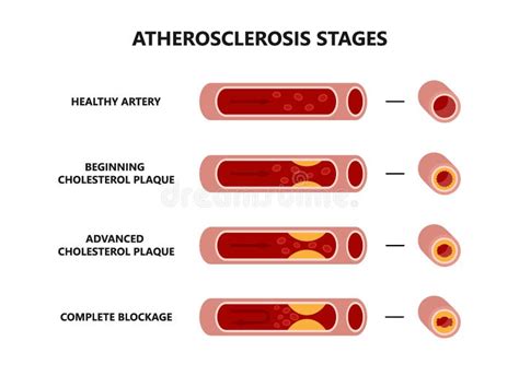 Atherosclerosis In Vessels Stock Vector Illustration Of Cell 62833733