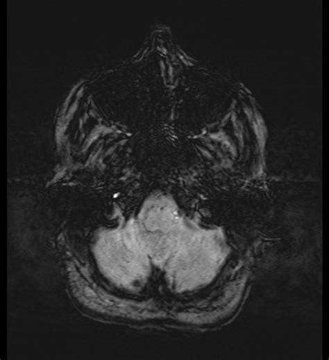 Choroid Plexus Xanthogranuloma Radiopaedia Axial Swi