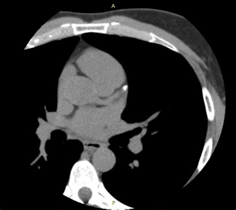 Coronary Calcium Score Insight Medical Imaging