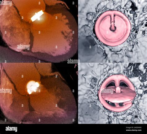 Aortic Valve Replacement Coloured 2D Left And 3D Right Computed