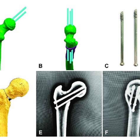 Fixation Of Pauwels Femoral Neck Fractures With Ihs A B Simulation