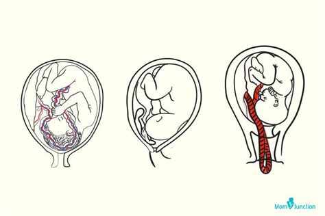 Cord Prolapse Causes Diagnosis And Management