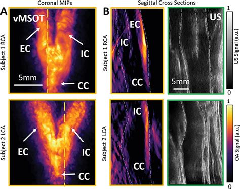 Real Time Volumetric Assessment Of The Human Carotid Artery Handheld