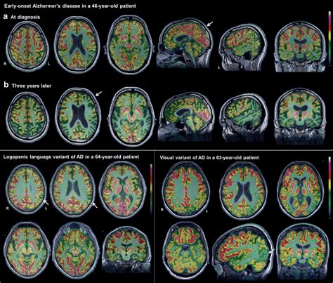 Representative Brain Fdg Petmri Scans Of Patients With Atypical Ad