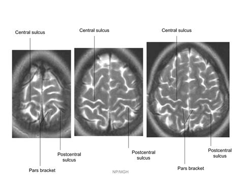 Ppt Parietal Lobe Ppt