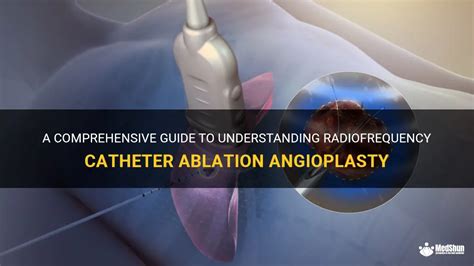 A Comprehensive Guide To Understanding Radiofrequency Catheter Ablation