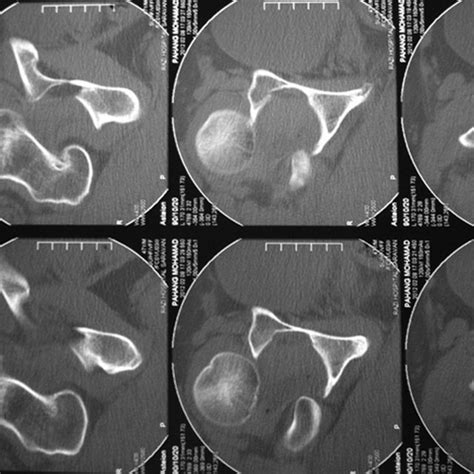 Ischial Tuberosity Avulsion Fracture A This Pelvis Radiograph Shows A