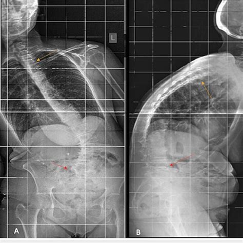 The Preoperative Anteroposterior A And Lateral B Radiographs Of A Download Scientific