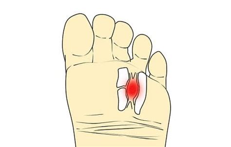 Neuroma De Morton Plantillas Y Tratamiento San Rom N