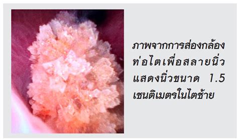 คอลัมน์ผู้หญิง แพทยสภา หมอชวนรู้ ‘นิ่วในไต