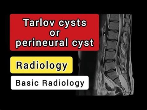 Tarlov Cysts Perineural Cysts Radiology Youtube