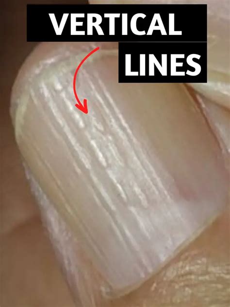 Vertical Lines On Nails And Their Causes Fun Channel