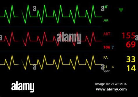 Looped Patient Monitor Displays Vital Signs ECG Electrocardiogram EKG