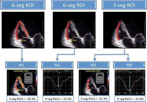 Sex And Method Specific Reference Values For Right Ventricular Strain