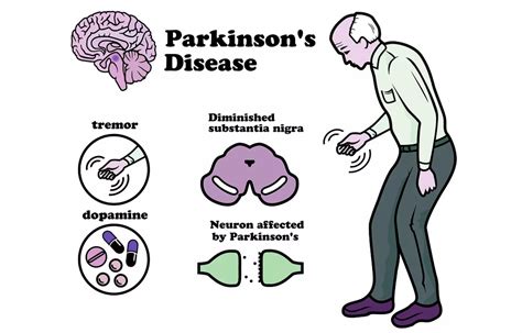 Parkinson Treatment - Neurotherapy Punjab, Neurotherapist Punjab,