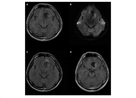 A 20 Year Old Man With Supratentorial Intraparenchymal Anaplastic