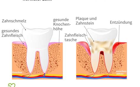 Parodontitis Ursachen Symptome Behandlung Onmeda De