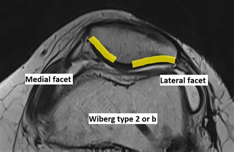 Patella Shape Wiberg Type 2 Or B Image