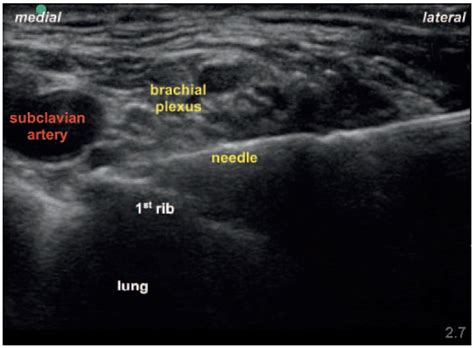 Ultrasound Guided Supraclavicular Brachial Plexus Block WFSA Resources