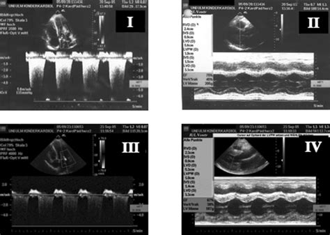 Doppler Echocardiographic Assessment Of Mitral Valve Regurgitation In