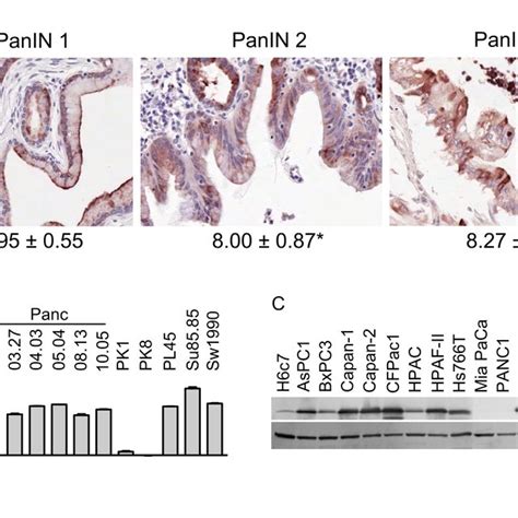 LCN2 Expression In Pancreatic Neoplastic Lesions And PDAC Cell Lines