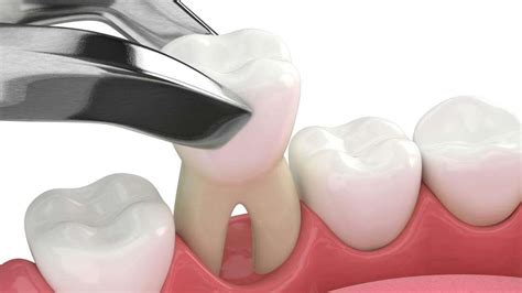 Understanding Tooth Extraction Healing Time What To Expect And How To Speed Up Recovery Tooth