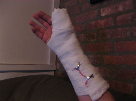 Broken Wrist Cast