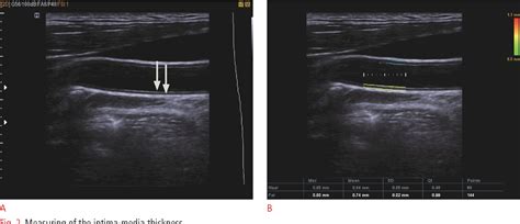 Figure 1 From General Principles Of Carotid Doppler Ultrasonography Semantic Scholar